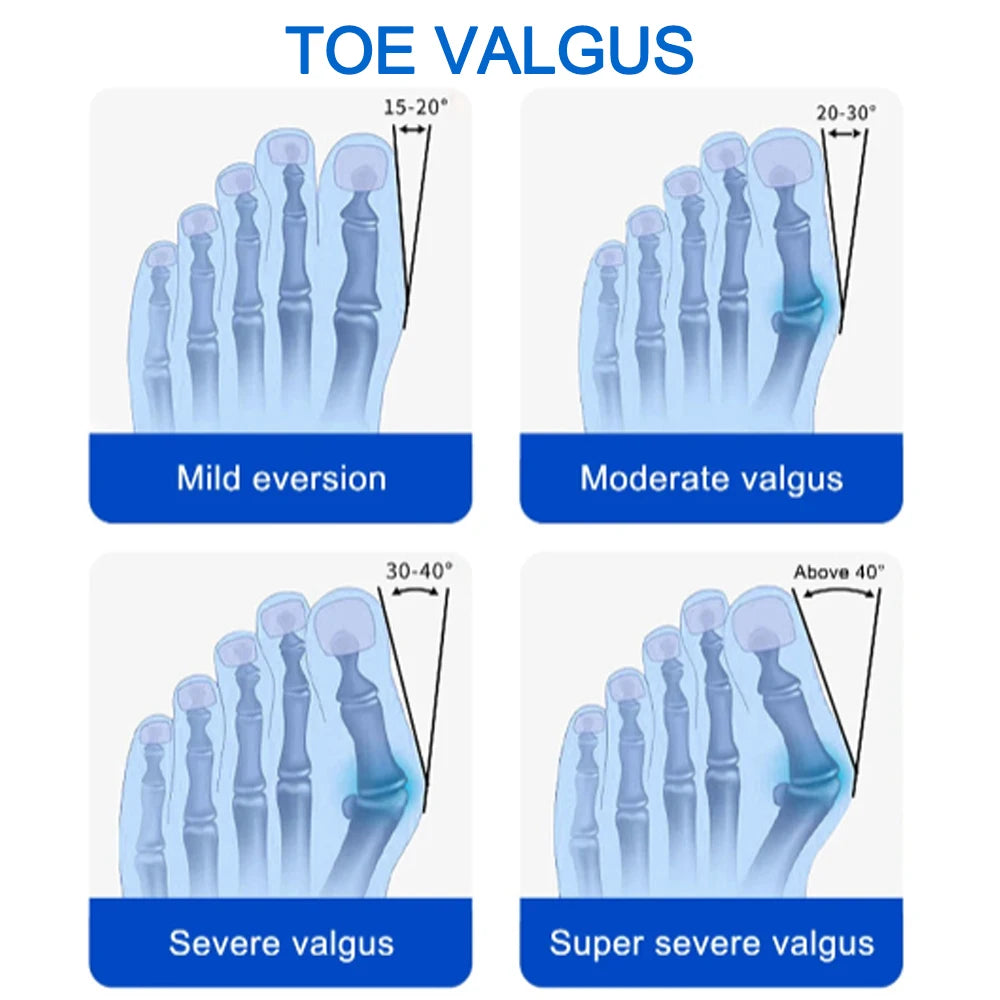Bunion Splint Big Toe Straightener Hallux Valgus Correction Orthotics Foot Bone Thumb Adjuster Correction Bunions Corrector